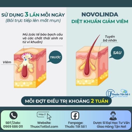 thuốc bôi trị mụn Novolinda trị mụn trứng cá viêm da tăng tiết bã nhờn thuoctotso1.com